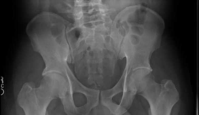 Is your sacro-iliac joint causing pain?