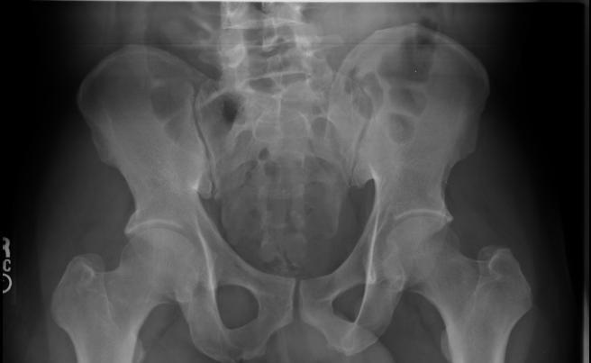 xray of a normal hip joint