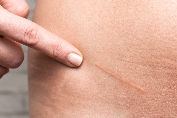 Scar Therapy