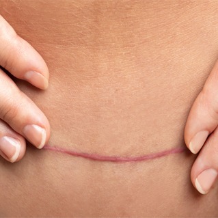 Scar Therapy