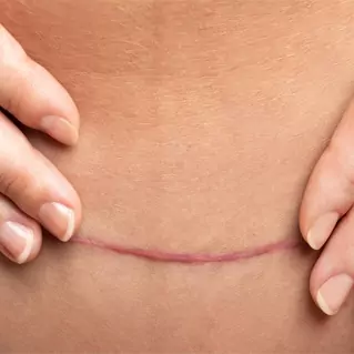 Scar Therapy
