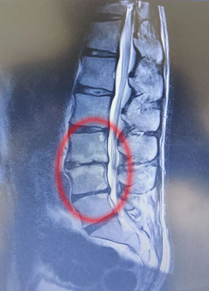 MRI broken