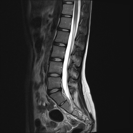 Normal Lumbar spine MRI